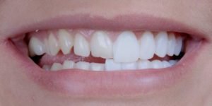 Le faccette dentali estetiche