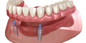 Protesi mobile su impianti tipo Overdenture