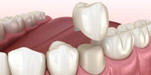 Protesi estetiche in Disilicato di Litio