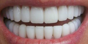 Protesi ad elevata biocompatibilità in zirconia