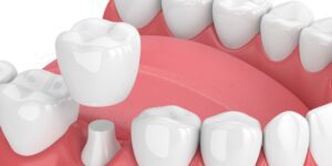 La corona dentale