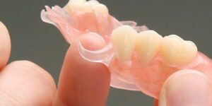 Protesi estetiche in Deflex