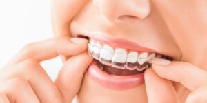 Correggere il disallineamento dentale